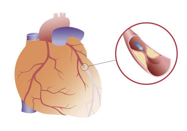 good-news-blood-test-heart-attack-stroke-risk