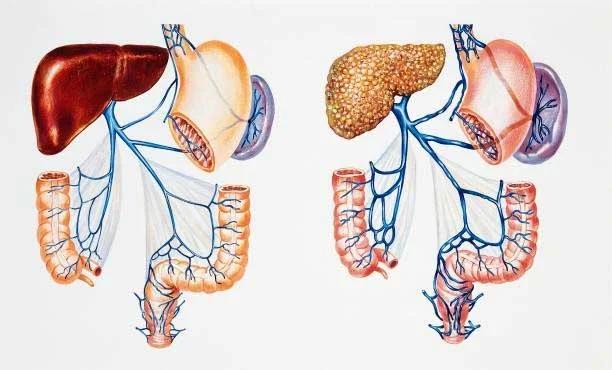 फैटी लिवर के 5 लक्षण, कारण और बचाव: घर पर कैसे करें जांच? 1 How to Check at Home Fatty Liver?